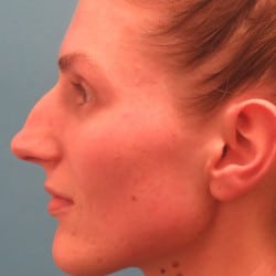 Before Image: Rhinoplasty by Dr. Henstrom - left-side