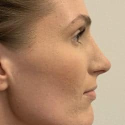 After Image: Rhinoplasty by Dr. Henstrom - right-side