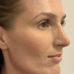 After Image: Rhinoplasty by Dr. Henstrom - right-front-oblique