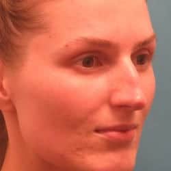 Before Image: Rhinoplasty by Dr. Henstrom - right-front-oblique