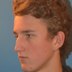 Before Image: Septorhinoplasty by Dr. Thompson - left-front-oblique