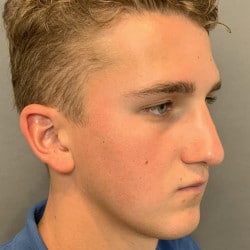 After Image: Septorhinoplasty by Dr. Thompson - right-front-oblique