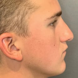 After Image: Septorhinoplasty by Dr. Thompson - right-side