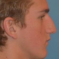 Before Image: Septorhinoplasty by Dr. Thompson - right-side