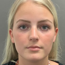 After Image: Rhinoplasty by Dr. Thompson - front