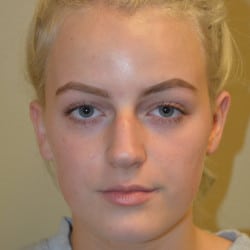 Before Image: Rhinoplasty by Dr. Thompson - front