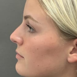 After Image: Rhinoplasty by Dr. Thompson - left-side