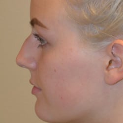 Before Image: Rhinoplasty by Dr. Thompson - left-side