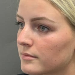 After Image: Rhinoplasty by Dr. Thompson - left-front-oblique