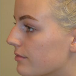 Before Image: Rhinoplasty by Dr. Thompson - left-front-oblique