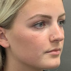 After Image: Rhinoplasty by Dr. Thompson - right-front-oblique