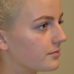 Before Image: Rhinoplasty by Dr. Thompson - right-front-oblique