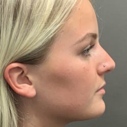 After Image: Rhinoplasty by Dr. Thompson - right-side
