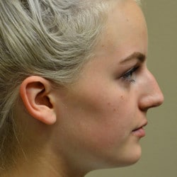 Before Image: Rhinoplasty by Dr. Thompson - right-side