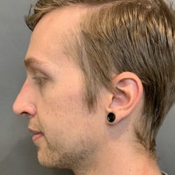 After Image: Septorhinoplasty by Dr. Thompson