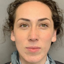 After Image: Septorhinoplasty by Dr. Thompson - front