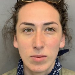 Before Image: Septorhinoplasty by Dr. Thompson - front