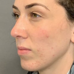 After Image: Septorhinoplasty by Dr. Thompson - left-front-oblique