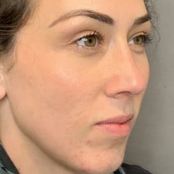 After Image: Septorhinoplasty by Dr. Thompson - right-front-oblique