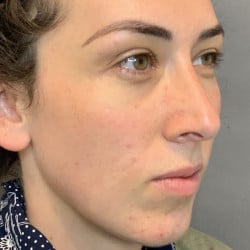Before Image: Septorhinoplasty by Dr. Thompson - right-front-oblique