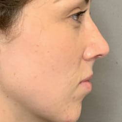 After Image: Septorhinoplasty by Dr. Thompson - right-side
