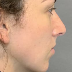 Before Image: Septorhinoplasty by Dr. Thompson - right-side
