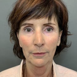 Before Image: Necklift by Dr. Thompson - front
