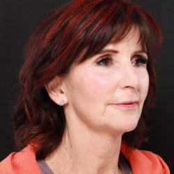 After Image: Necklift by Dr. Thompson - right-front-oblique