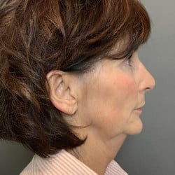 Before Image: Necklift by Dr. Thompson - right-side