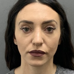 After Image: Septorhinoplasty by Dr. Henstrom - front