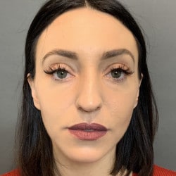 Before Image: Septorhinoplasty by Dr. Henstrom - front