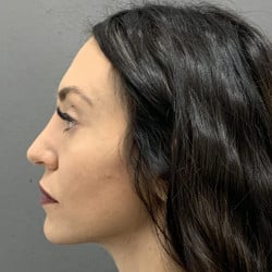 After Image: Septorhinoplasty by Dr. Henstrom - left-side