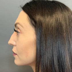 Before Image: Septorhinoplasty by Dr. Henstrom - left-side