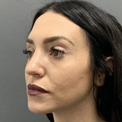 After Image: Septorhinoplasty by Dr. Henstrom - left-front-oblique