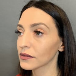 Before Image: Septorhinoplasty by Dr. Henstrom - left-front-oblique