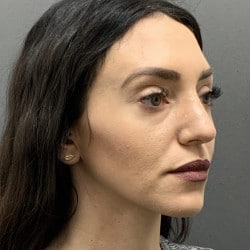 After Image: Septorhinoplasty by Dr. Henstrom - right-front-oblique