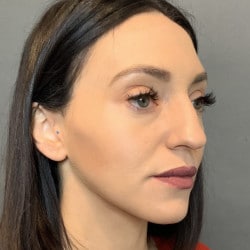 Before Image: Septorhinoplasty by Dr. Henstrom - right-front-oblique