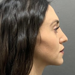 After Image: Septorhinoplasty by Dr. Henstrom - right-side