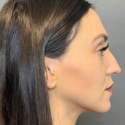 Before Image: Septorhinoplasty by Dr. Henstrom - right-side