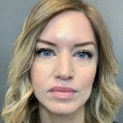 Before Image: Revision Rhinoplasty by Dr. Henstrom - front