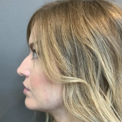 Before Image: Revision Rhinoplasty by Dr. Henstrom - left-side