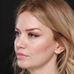 After Image: Revision Rhinoplasty by Dr. Henstrom - left-front-oblique