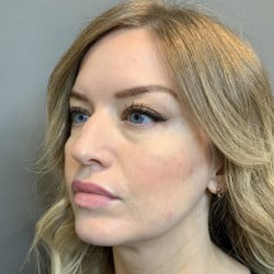 Before Image: Revision Rhinoplasty by Dr. Henstrom - left-front-oblique