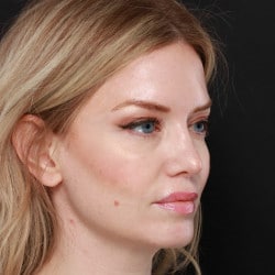 After Image: Revision Rhinoplasty by Dr. Henstrom - right-front-oblique