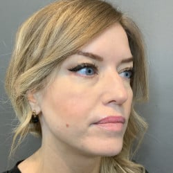 Before Image: Revision Rhinoplasty by Dr. Henstrom - right-front-oblique