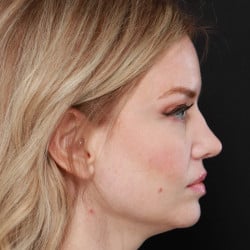 After Image: Revision Rhinoplasty by Dr. Henstrom - right-side