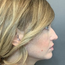 Before Image: Revision Rhinoplasty by Dr. Henstrom - right-side