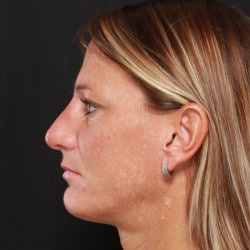 After Image: Rhinoplasty by Dr. Henstrom - left-side