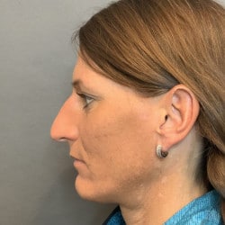 Before Image: Rhinoplasty by Dr. Henstrom - left-side