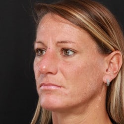 After Image: Rhinoplasty by Dr. Henstrom - left-front-oblique